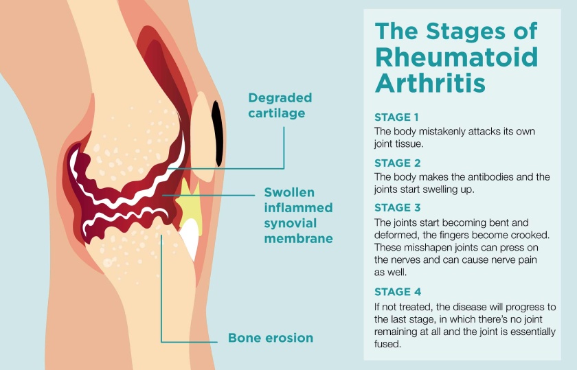 Rheumatoid arthritis and temporomandibular joint disorder