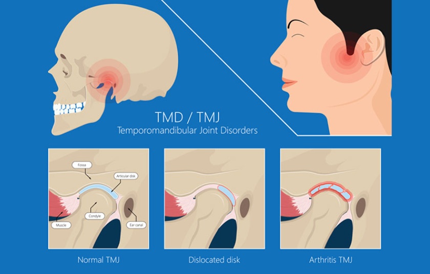 Temporomandibular joint disorders