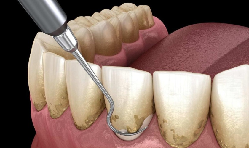 Getting tartar periodically is an effective way to prevent bad breath