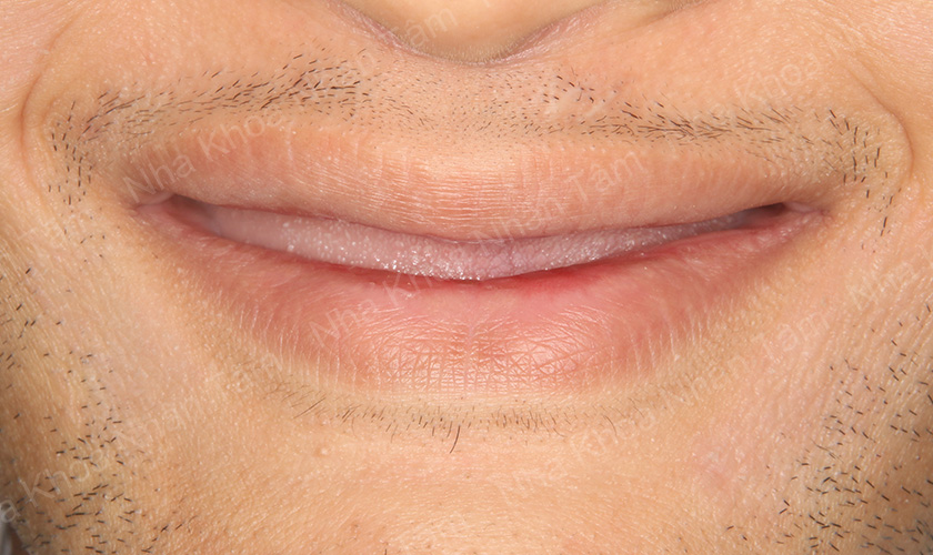 Literally toothless man treated by doctors in Ho Chi Minh City