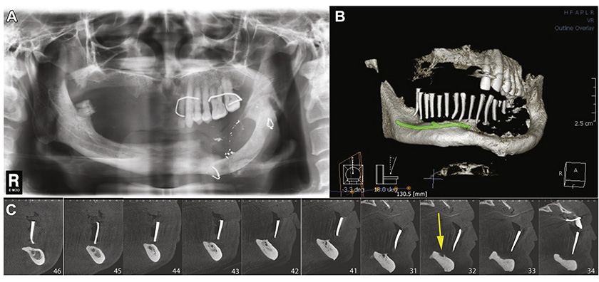 New breakthrough in Implant Dentistry in Vietnam