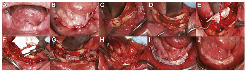 New breakthrough in Implant Dentistry in Vietnam