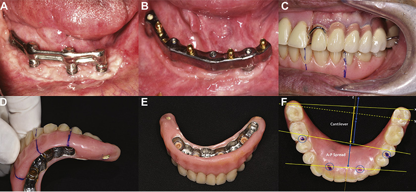New breakthrough in Implant Dentistry in Vietnam