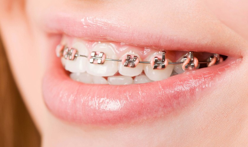 tooth extraction for braces