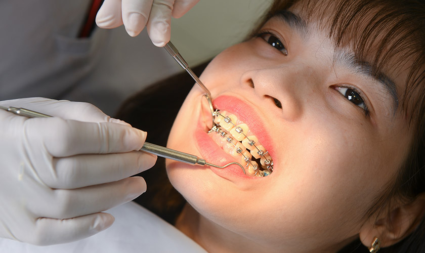 tooth extraction for braces