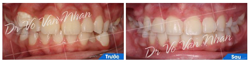 Khách hàng niềng răng tại Nha khoa Nhân Tâm