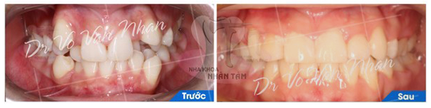 Khách hàng niềng răng tại Nha khoa Nhân Tâm