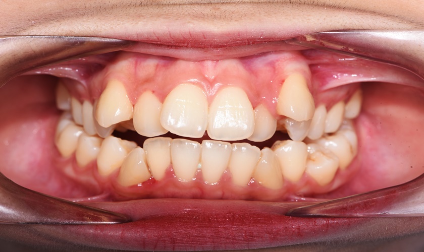 Braces for diviated teeth