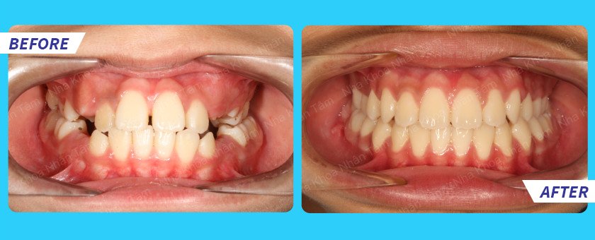 Results of orthodontics treatment at Nhan Tam Dental