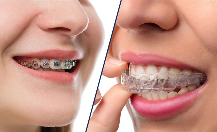 Invisalign braces and traditional braces