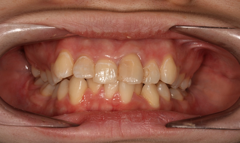 Cases that should be treated by braces