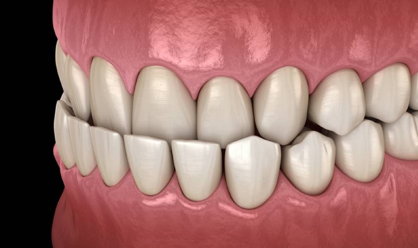 Underbite