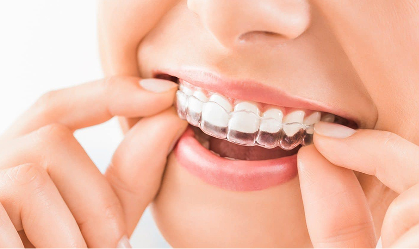 With transparent trays, others will find it difficult to recognize that you are braces