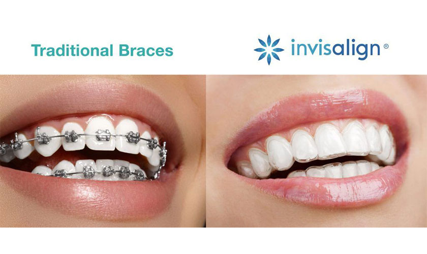 With Invisalign, you will feel comfortable, eat and talk as easily as normal