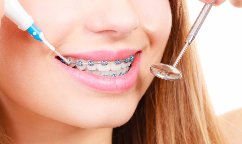 While wearing braces, use soft interdental brushes for dental hygiene