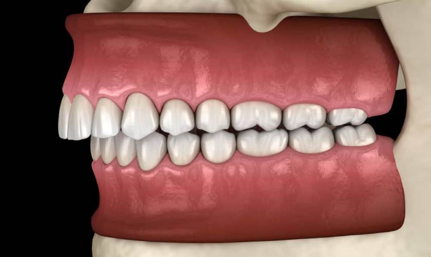 Protrusion braces treatment with modern technology
