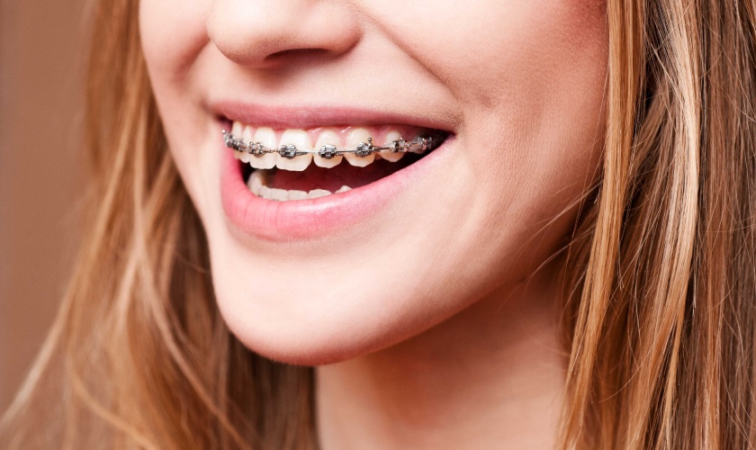 Braces are the best solution for impacted teeth