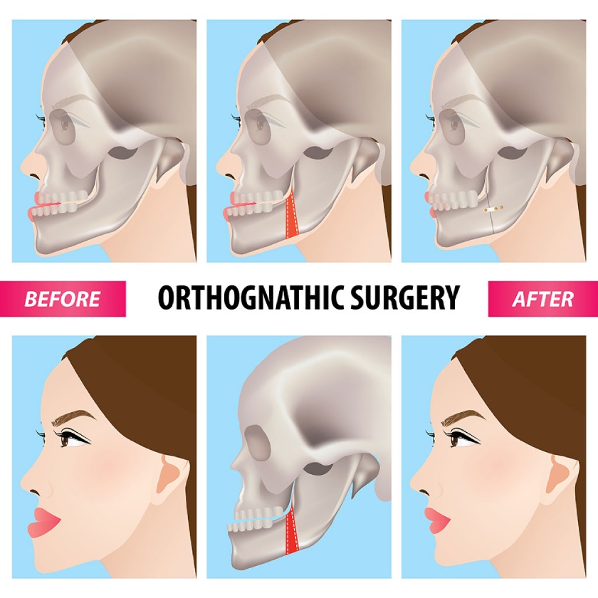 Surgical Orthodontics