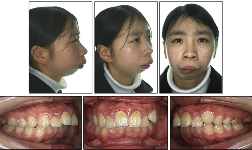 Surgical Orthodontics