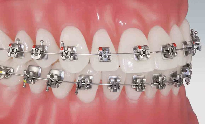The metal braces