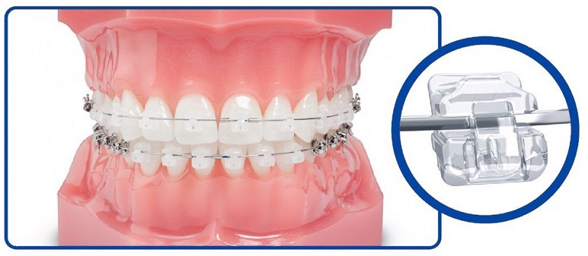 To wear braces with porcelain