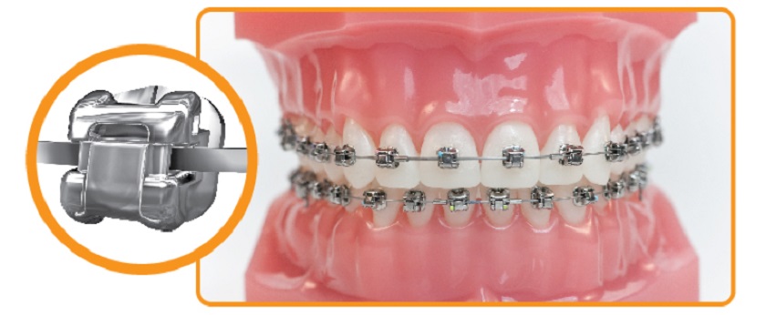 Self-ligating braces