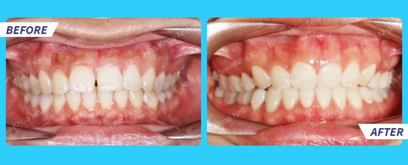 What is orthodontic treatment? - Nha Khoa Numberone