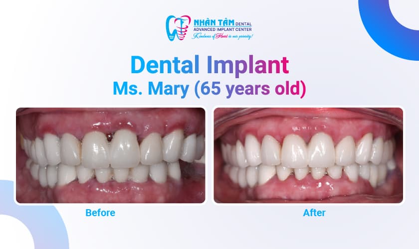 Hình: Finding Happiness with a New Smile at Nhan Tam Dental