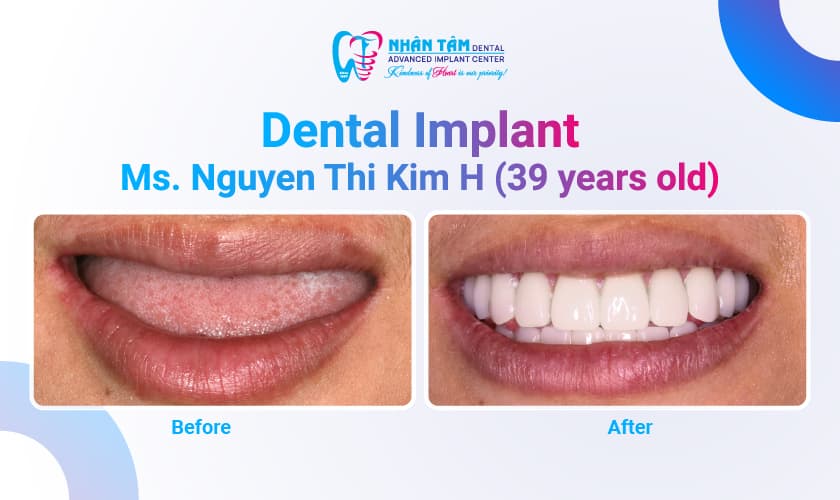 Hình: Born Without Teeth: Finding a Smile After 30 Years