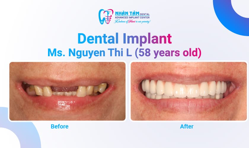 Hình: Dental Implants: Restore Your Smile & Chewing Function