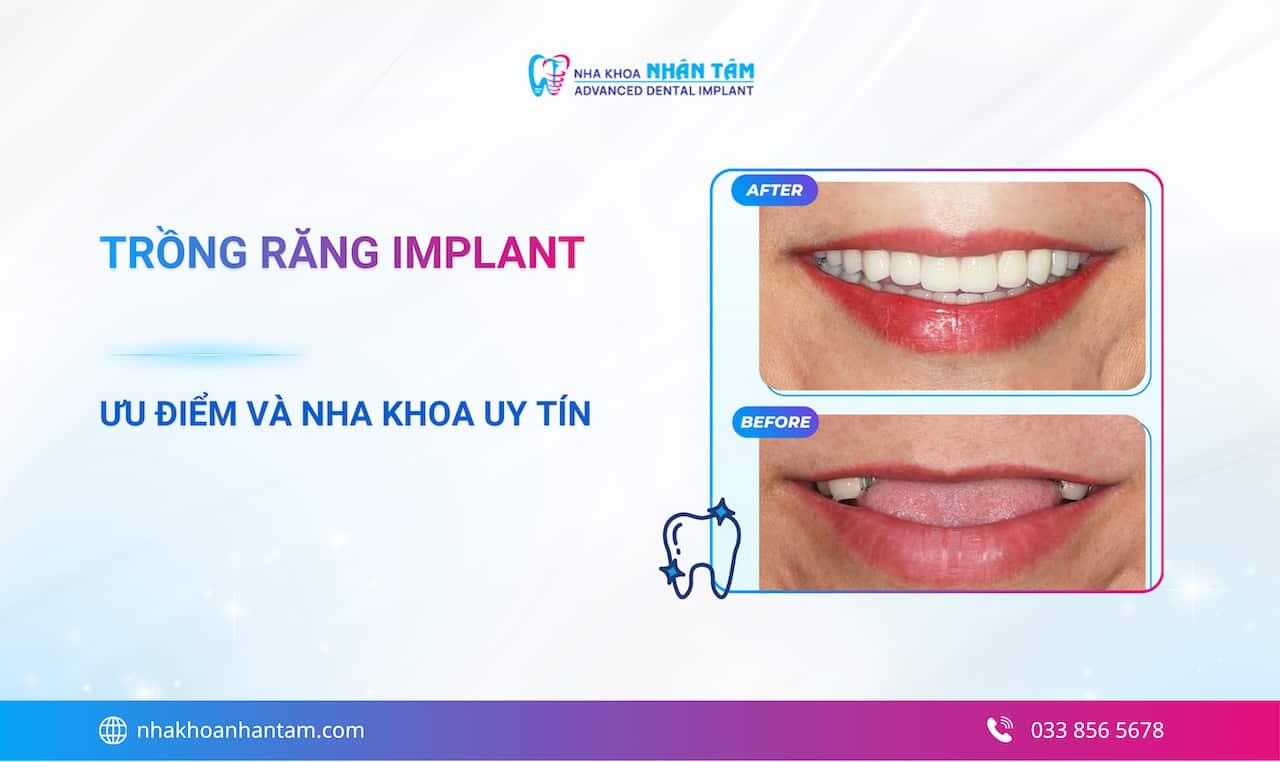 What is a dental implant? Advantages of dental implant placement in 2026