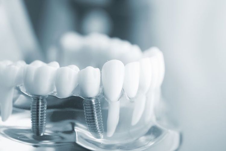 What is Dental Implant surgery?