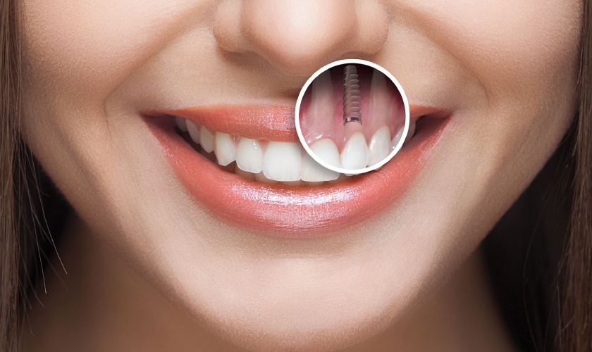 cay ghep implant