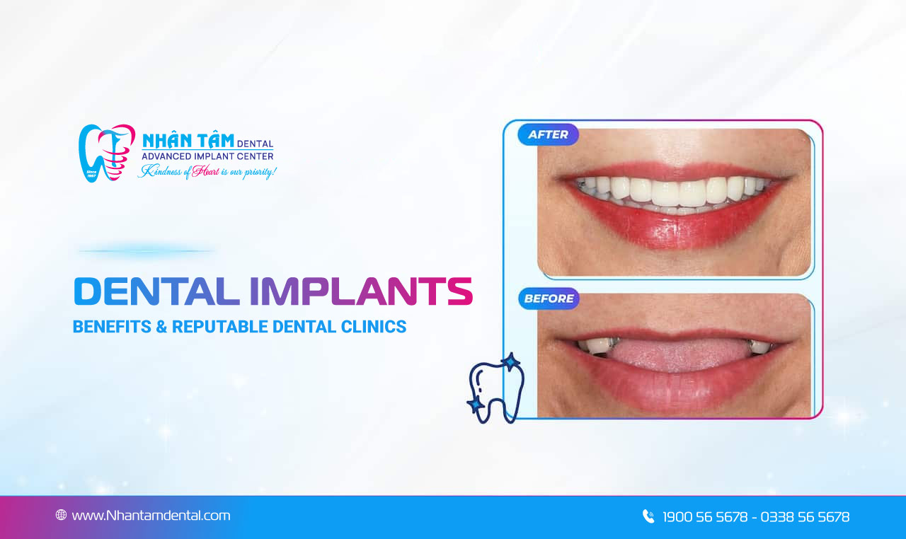 What is a dental implant? Advantages of dental implant placement in 2026 What is a dental implant? Advantages of dental implant placement in 2026