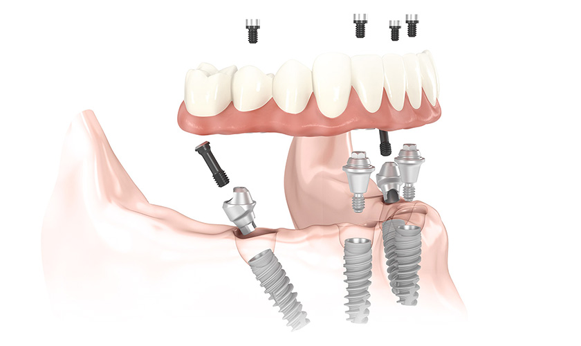 All-on-4 implant - The complete dental restoration method for the elderly