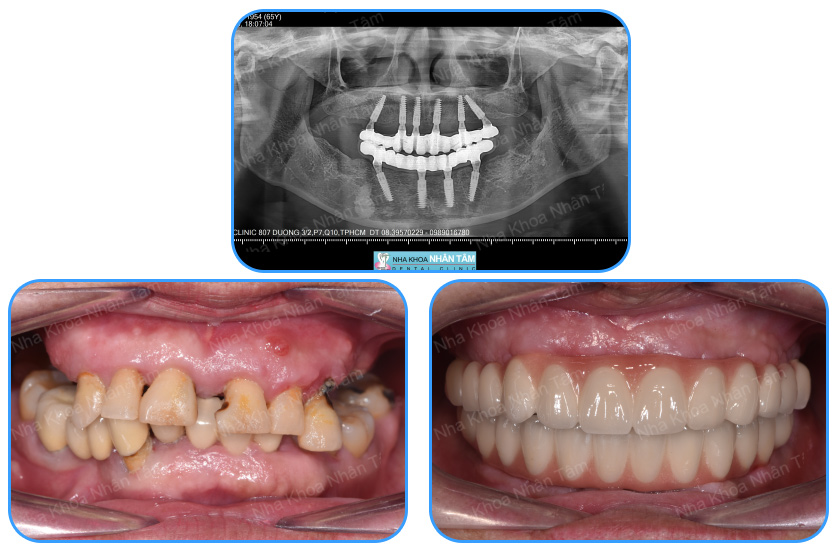 Patients with All-on-4 dental implant at Nhan Tam Dental