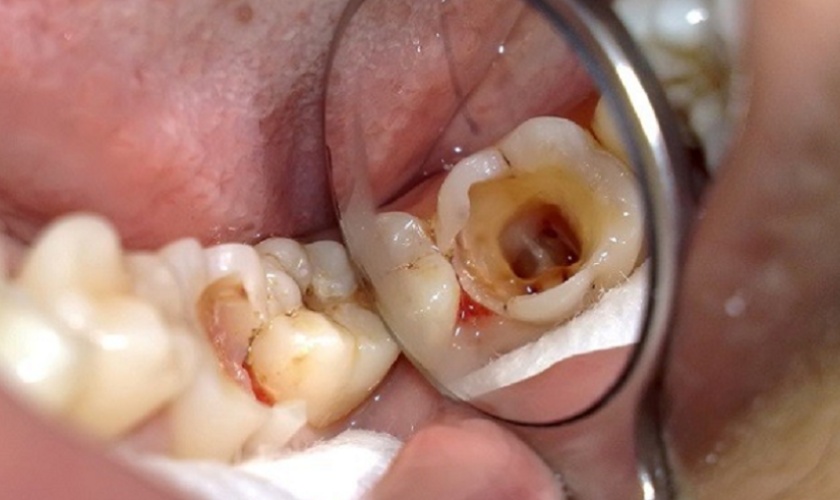 Dental caries