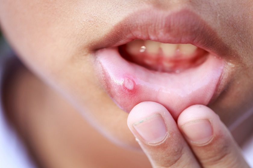 Ngăn ngừa bệnh ung thư ở người già