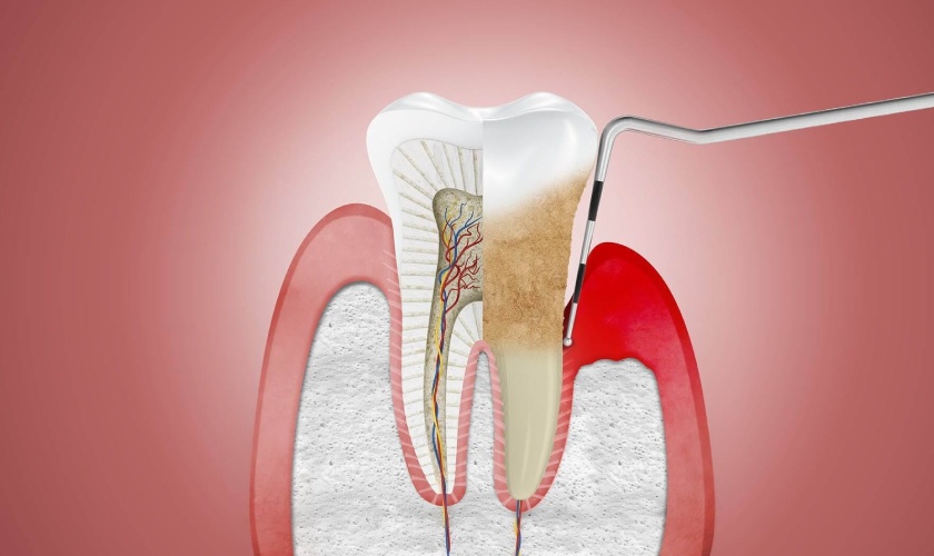 Periodontal disease