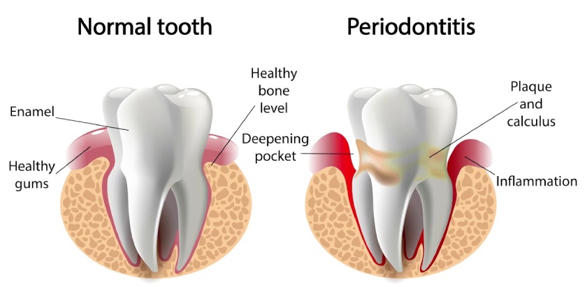 Advanced stages of periodontal disease