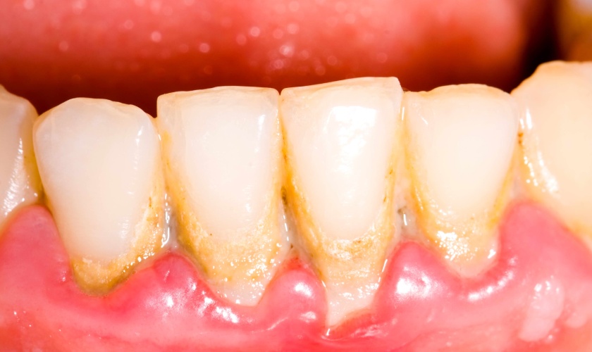 Symptoms of periodontal disease