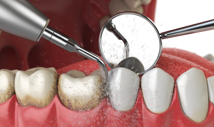 Treatment of periodontal disease