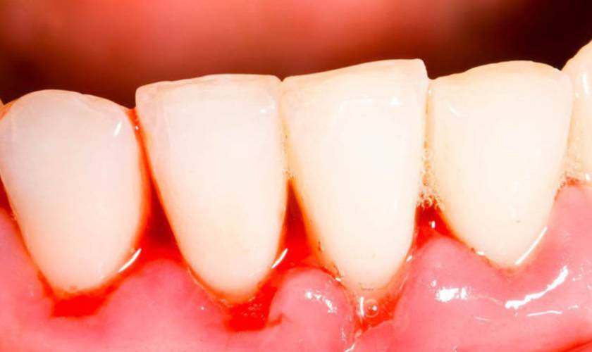 Gum infection leads to bleeding