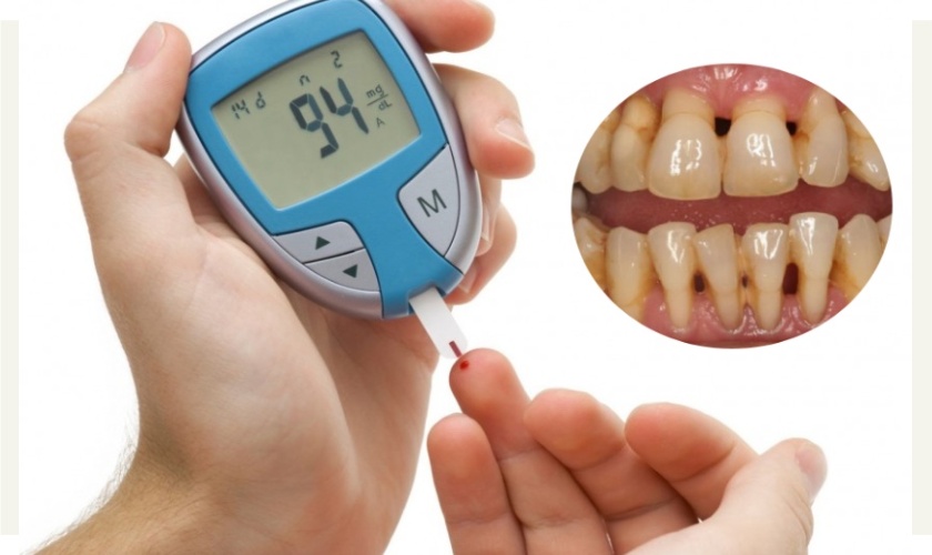 The relationship between periodontitis and diabetes