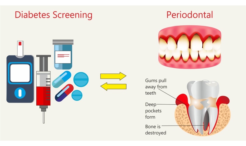 The relationship between periodontitis and diabetes