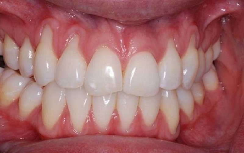 Aesthetics shaping for exposed gums