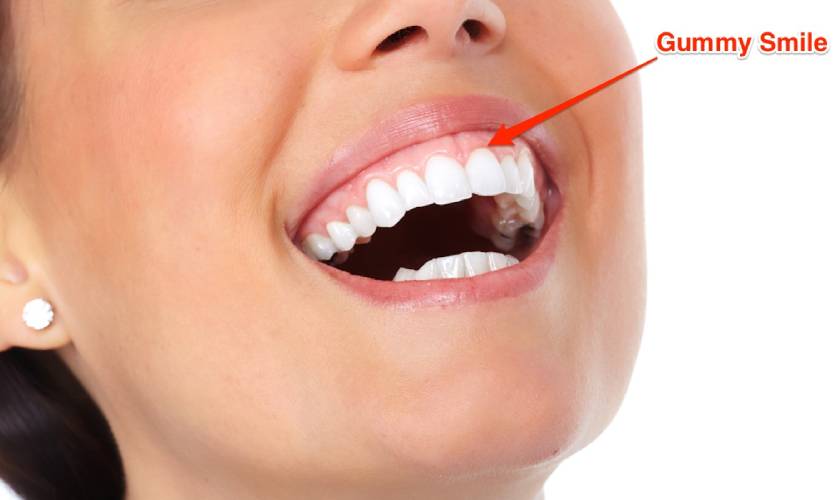 Causes of a Gummy Smile