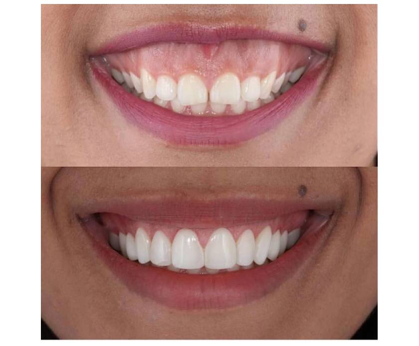 Gummy Smile Treatments