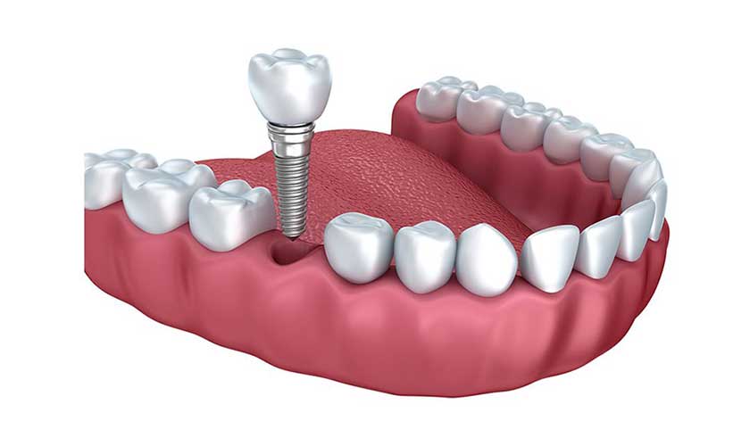 People with diabetes can have dental implants if the disease is controlled