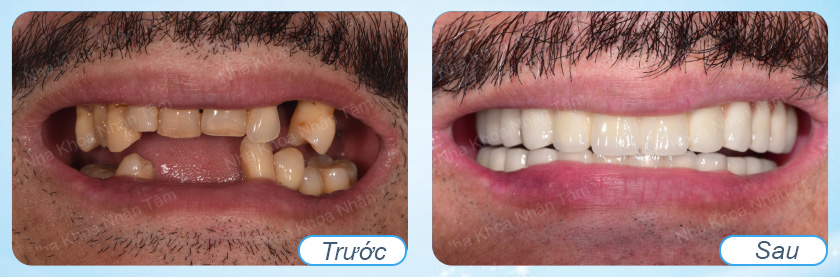 Implant teeth bring aesthetics and ensure chewing function like real teeth